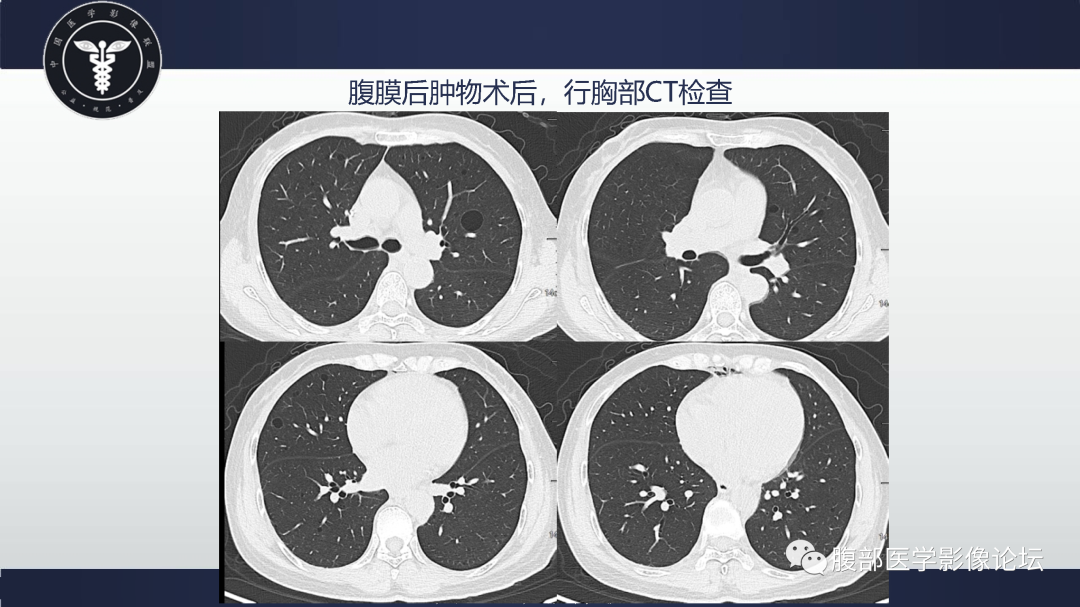 影像PPT - 【病例】腹膜后淋巴管肌瘤病1例CT影像-8 影像PPT - 【病例】腹膜后淋巴管肌瘤病1例CT影像-8