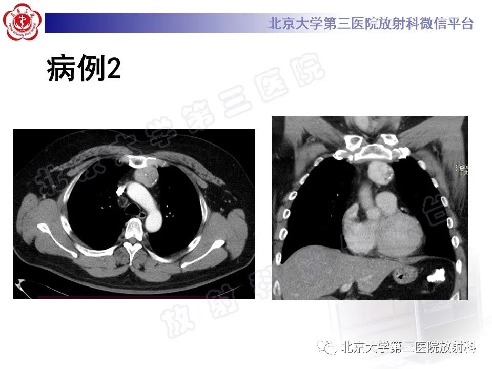 影像PPT - 【PPT】胸骨后甲状腺肿-4