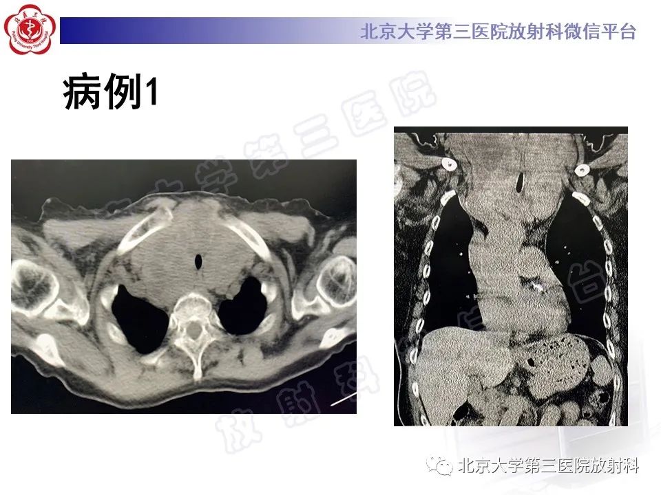影像PPT - 【PPT】胸骨后甲状腺肿-3