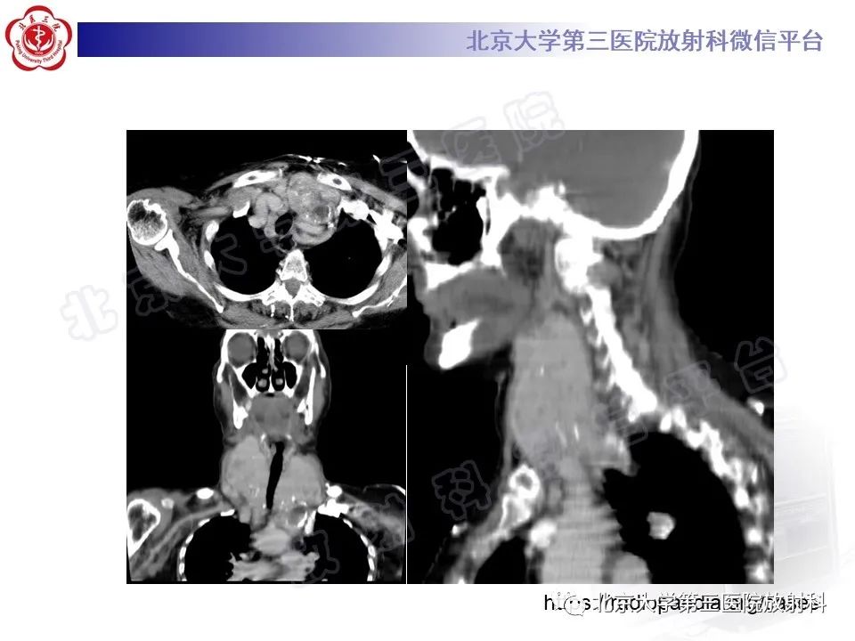 影像PPT - 【PPT】胸骨后甲状腺肿-14