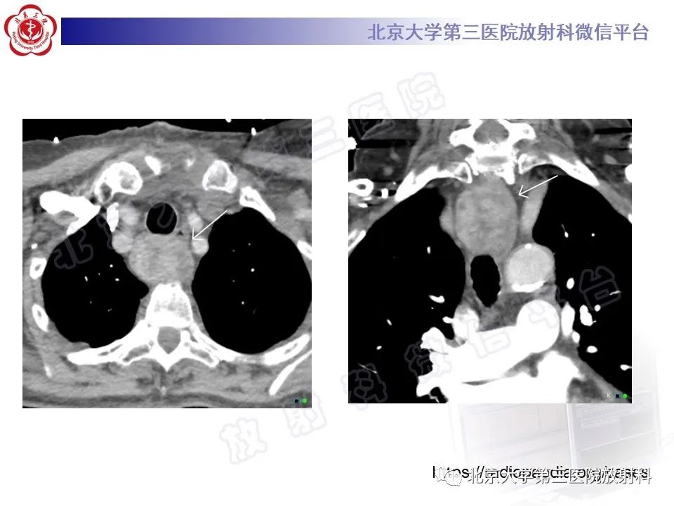 影像PPT - 【PPT】胸骨后甲状腺肿-15