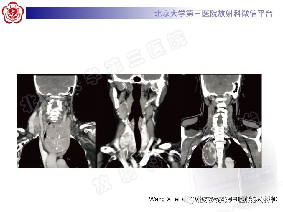 影像PPT - 【PPT】胸骨后甲状腺肿-17