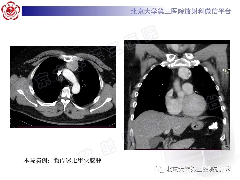 影像PPT - 【PPT】胸骨后甲状腺肿-18