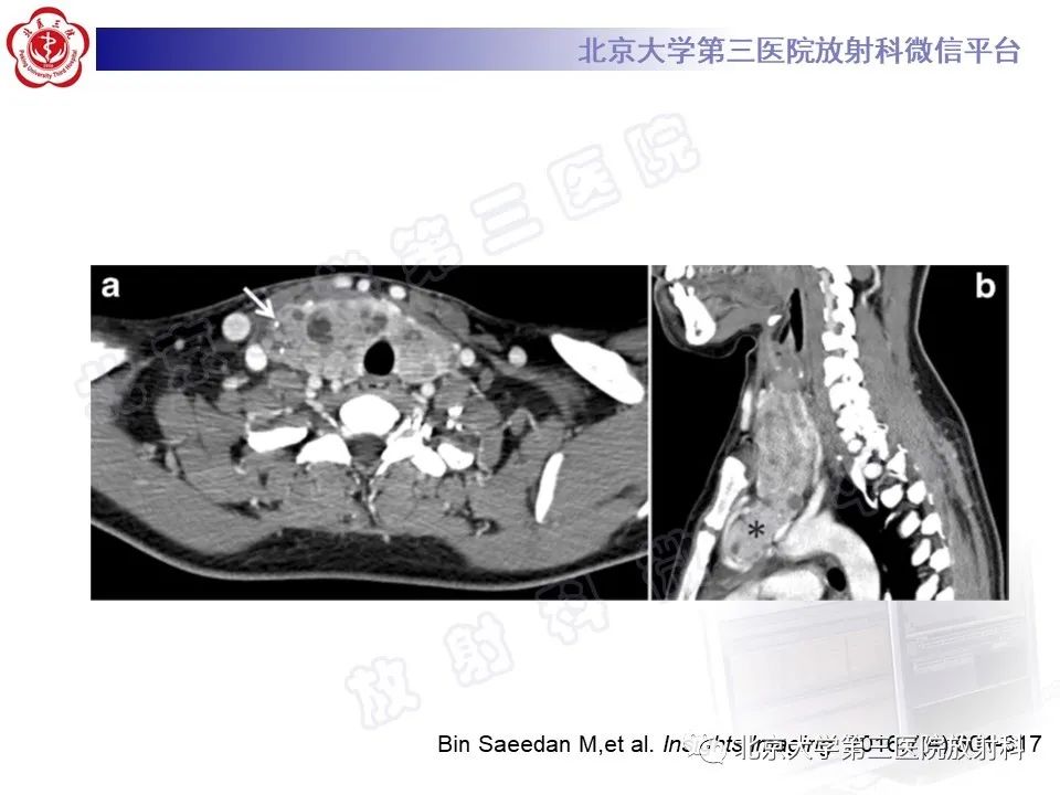 影像PPT - 【PPT】胸骨后甲状腺肿-16