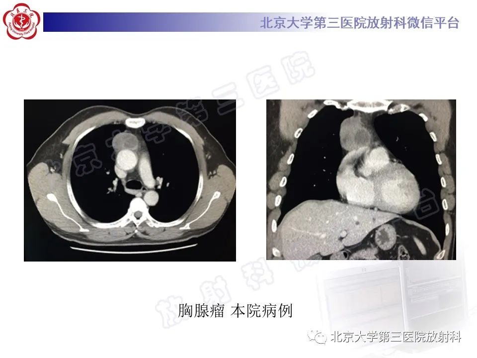 影像PPT - 【PPT】胸骨后甲状腺肿-21
