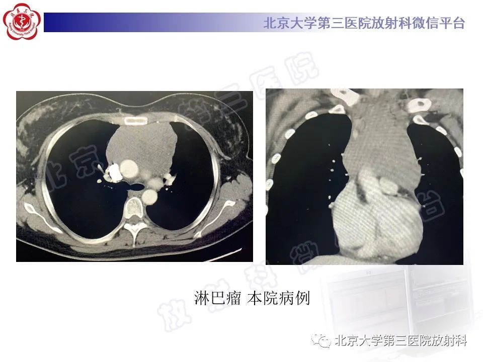 影像PPT - 【PPT】胸骨后甲状腺肿-23