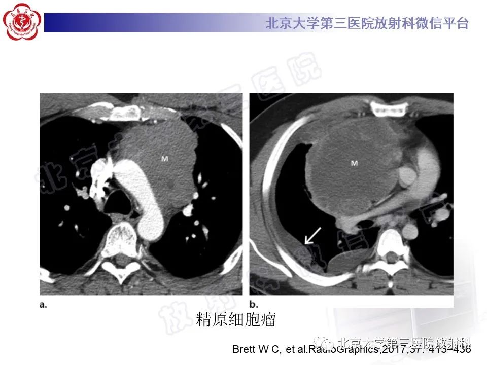 影像PPT - 【PPT】胸骨后甲状腺肿-25