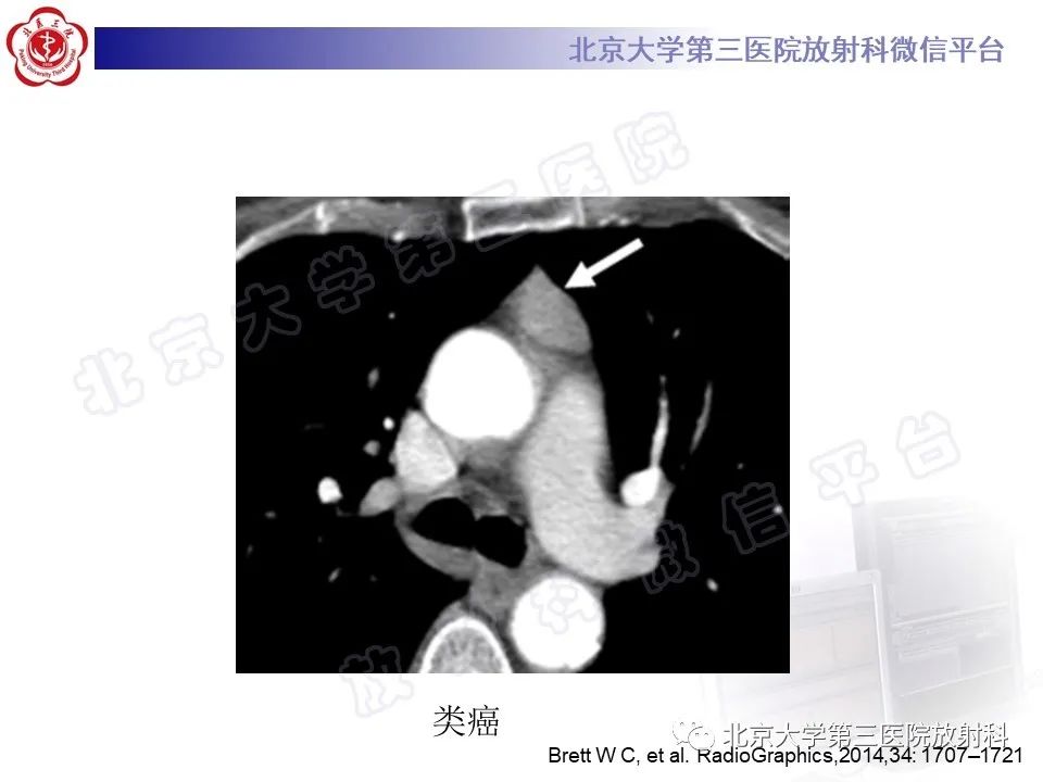 影像PPT - 【PPT】胸骨后甲状腺肿-27
