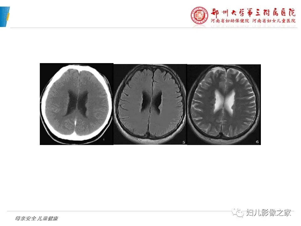影像PPT - 【PPT】脑神经元移行异常（NMD）-11