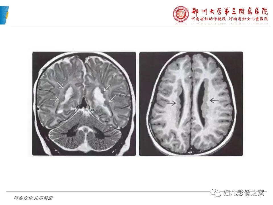 影像PPT - 【PPT】脑神经元移行异常（NMD）-12
