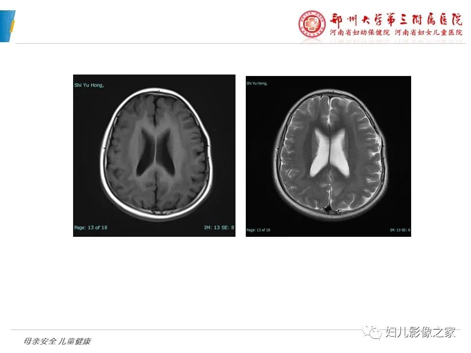 影像PPT - 【PPT】脑神经元移行异常（NMD）-16