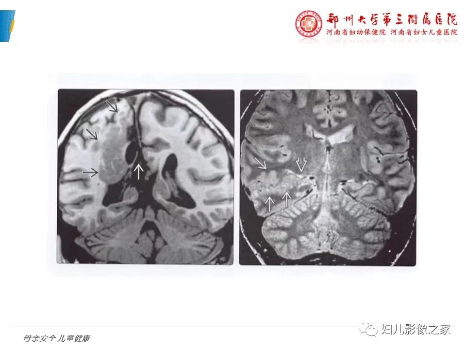 影像PPT - 【PPT】脑神经元移行异常（NMD）-14