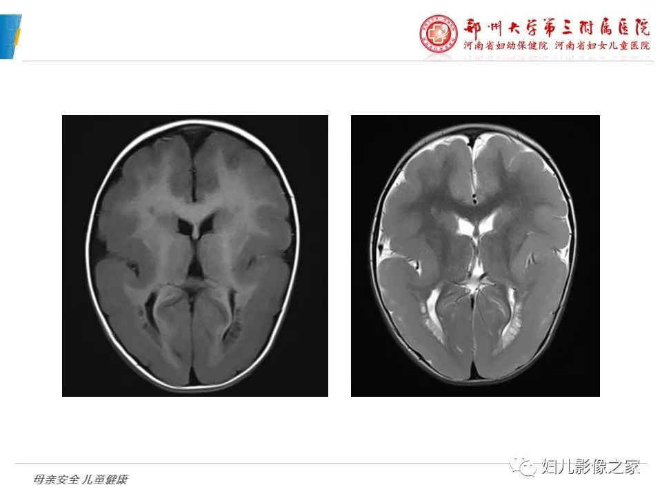 影像PPT - 【PPT】脑神经元移行异常（NMD）-21