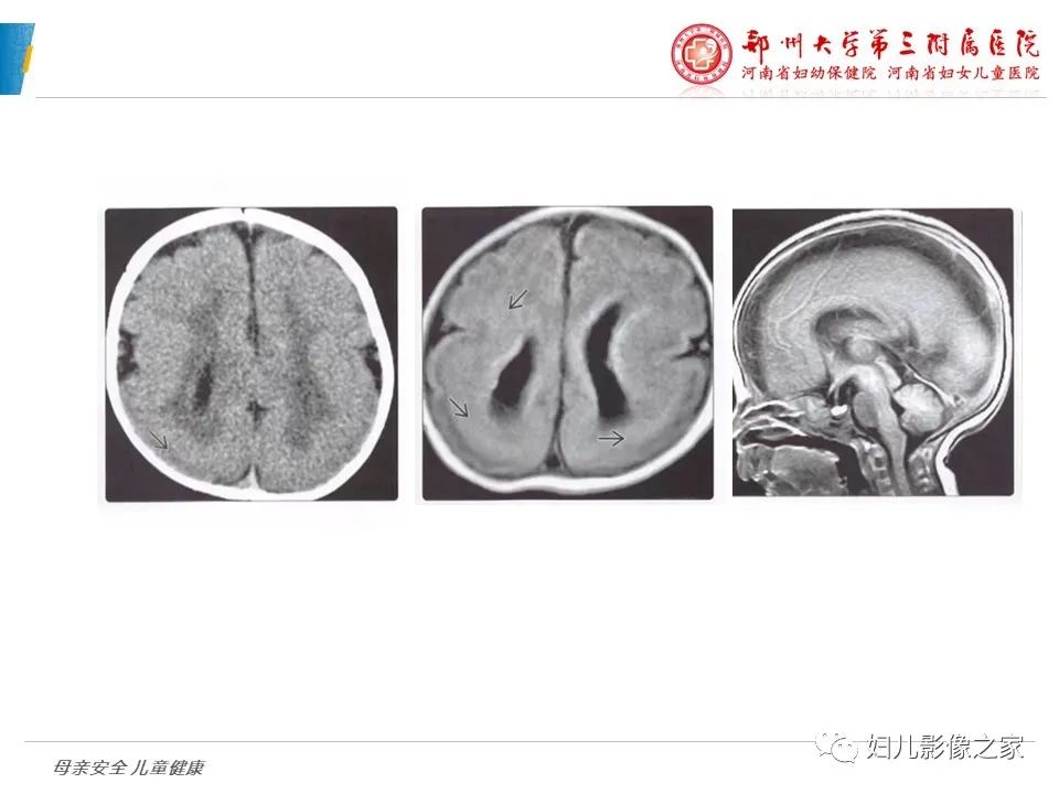 影像PPT - 【PPT】脑神经元移行异常（NMD）-24