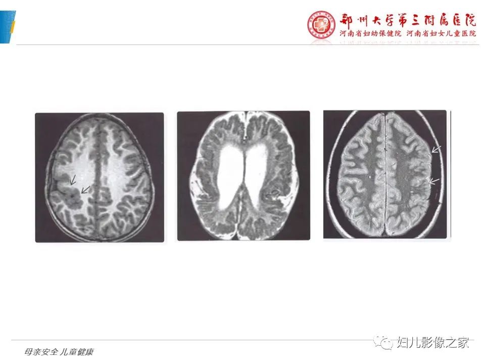 影像PPT - 【PPT】脑神经元移行异常（NMD）-27