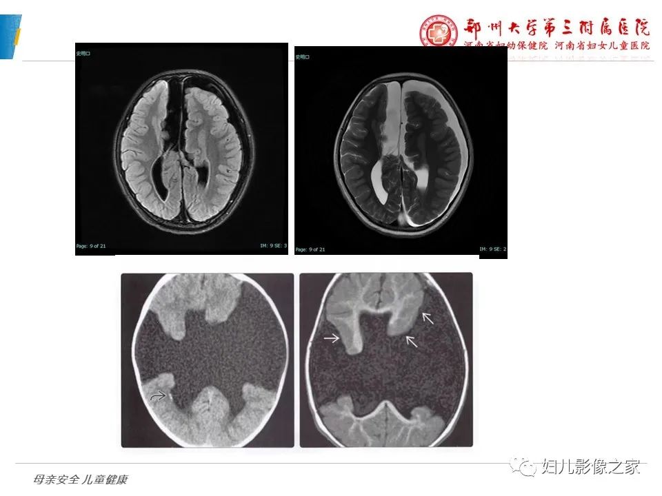 影像PPT - 【PPT】脑神经元移行异常（NMD）-30