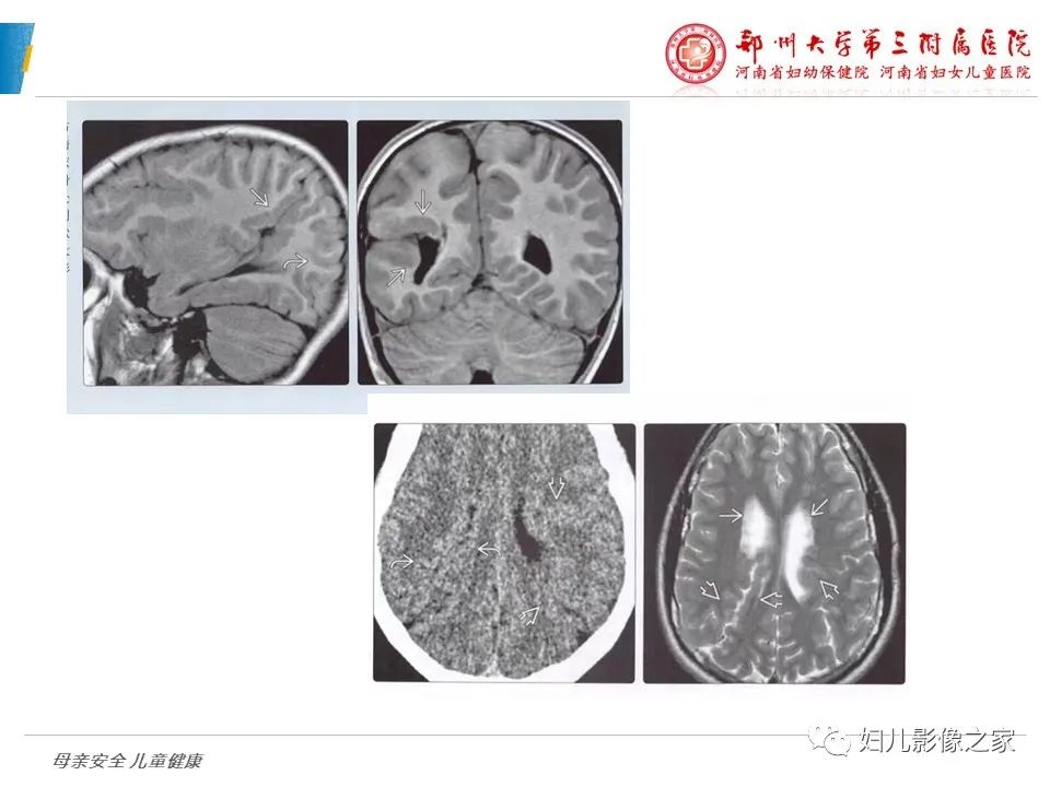 影像PPT - 【PPT】脑神经元移行异常（NMD）-31