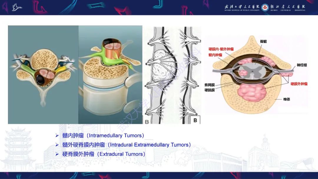 影像PPT - 【PPT】椎管内孤立性纤维瘤/血管外皮细胞瘤影像诊断-8