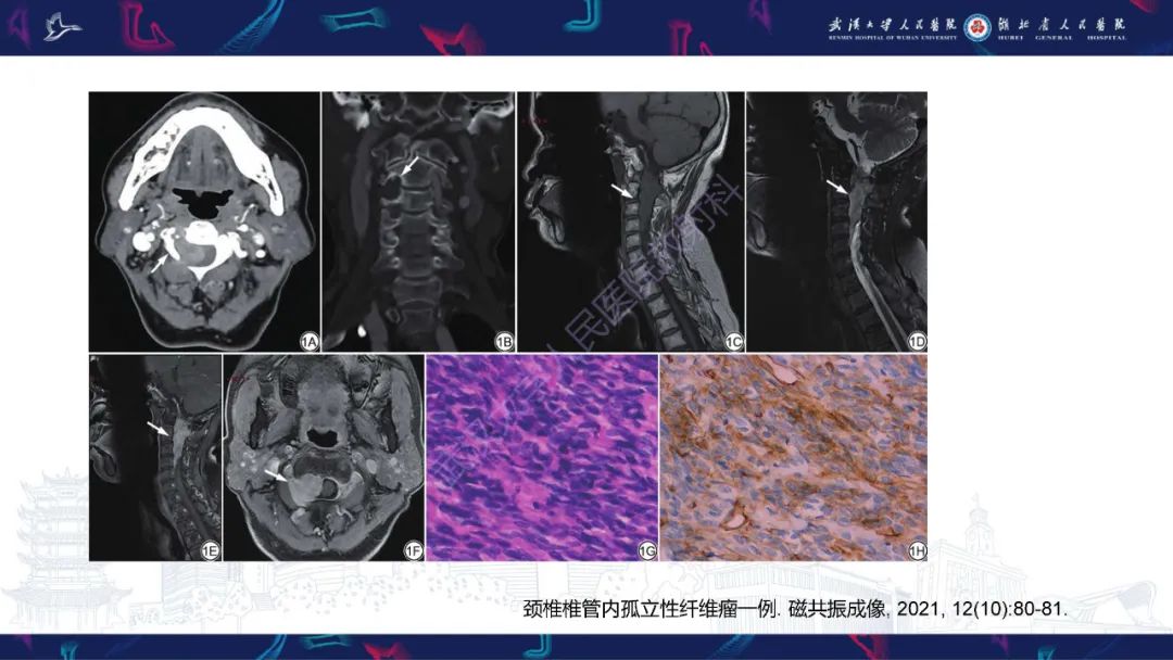 影像PPT - 【PPT】椎管内孤立性纤维瘤/血管外皮细胞瘤影像诊断-18