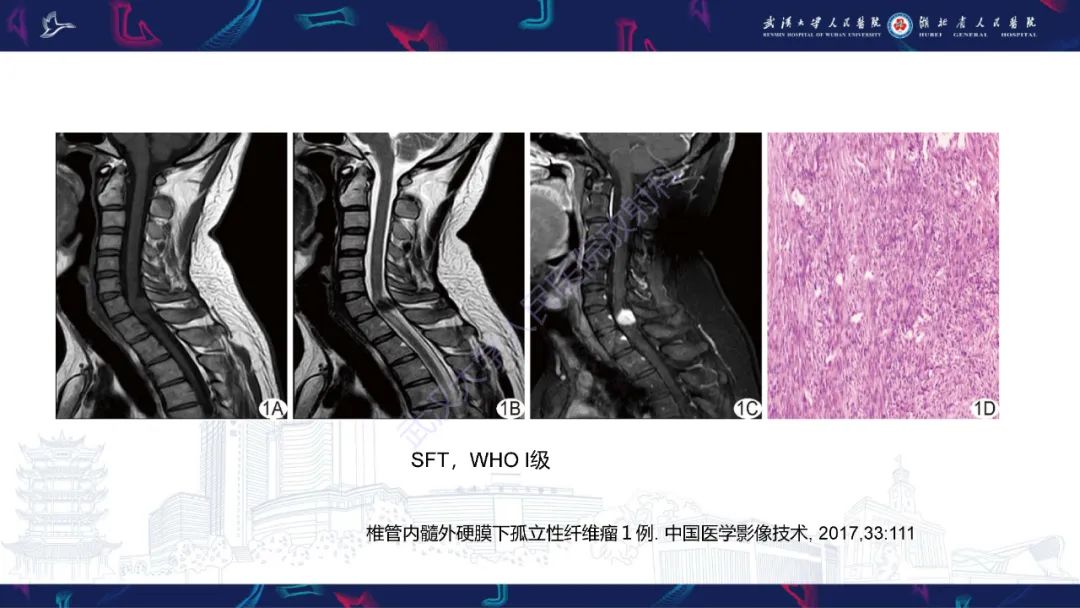 影像PPT - 【PPT】椎管内孤立性纤维瘤/血管外皮细胞瘤影像诊断-19