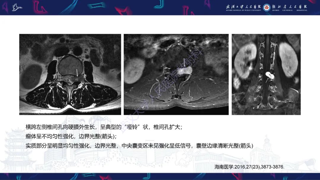 影像PPT - 【PPT】椎管内孤立性纤维瘤/血管外皮细胞瘤影像诊断-23