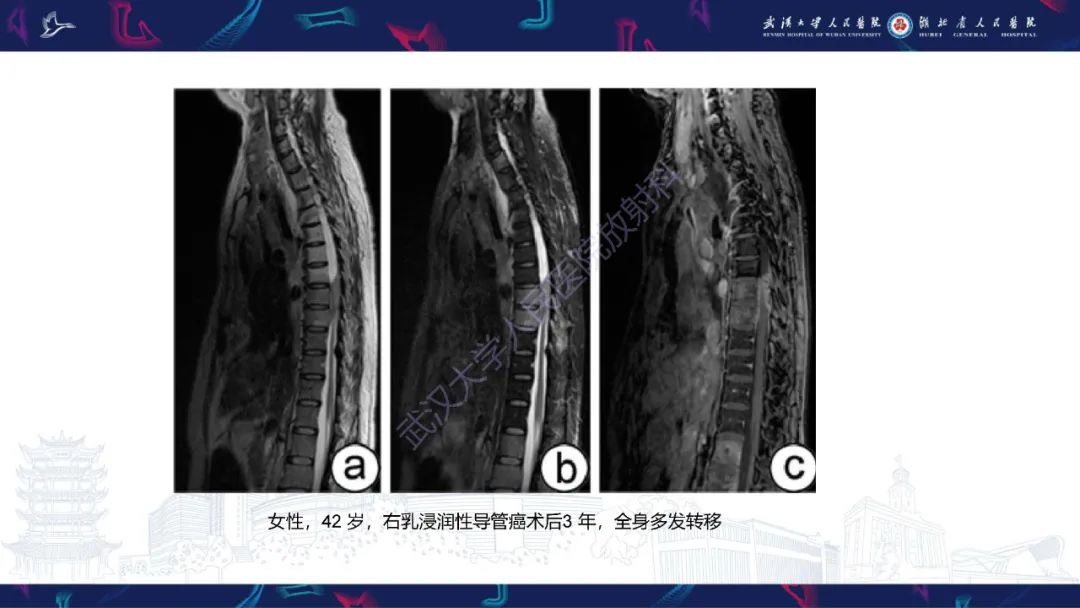 影像PPT - 【PPT】椎管内孤立性纤维瘤/血管外皮细胞瘤影像诊断-27