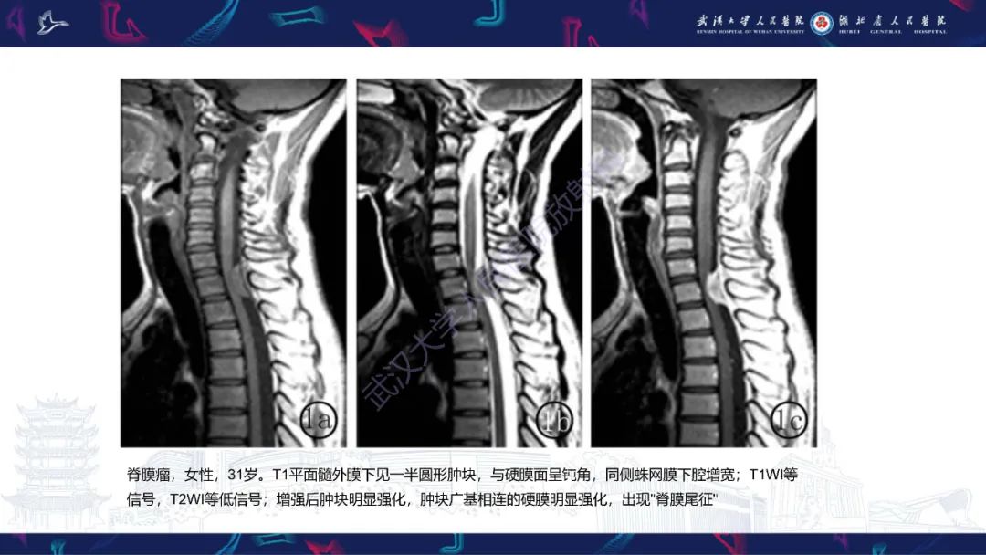 影像PPT - 【PPT】椎管内孤立性纤维瘤/血管外皮细胞瘤影像诊断-25