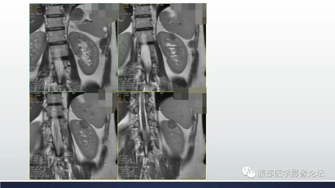 影像PPT - 【病例】肾脏血管平滑肌脂肪瘤1例MR-6