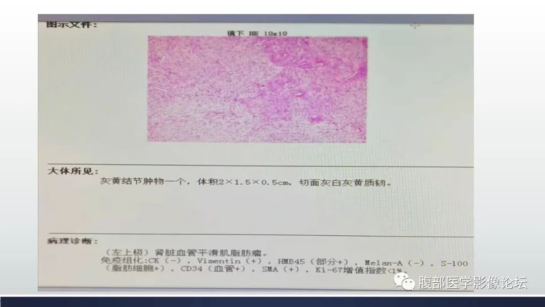 影像PPT - 【病例】肾脏血管平滑肌脂肪瘤1例MR-13