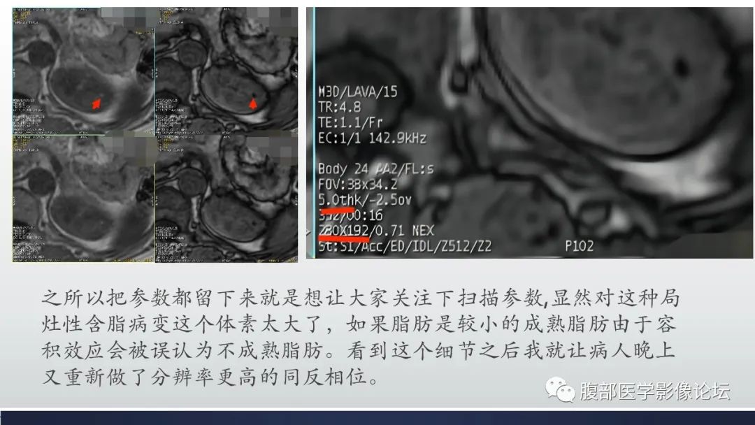 影像PPT - 【病例】肾脏血管平滑肌脂肪瘤1例MR-15