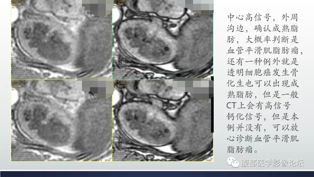 影像PPT - 【病例】肾脏血管平滑肌脂肪瘤1例MR-16