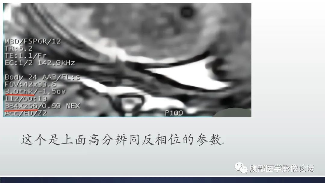 影像PPT - 【病例】肾脏血管平滑肌脂肪瘤1例MR-17