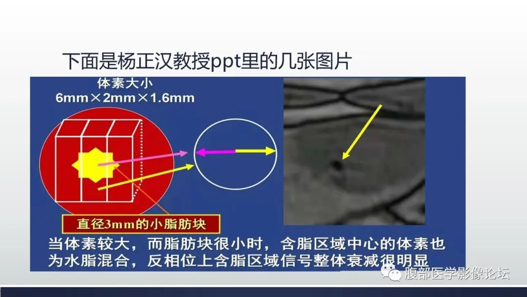 影像PPT - 【病例】肾脏血管平滑肌脂肪瘤1例MR-18
