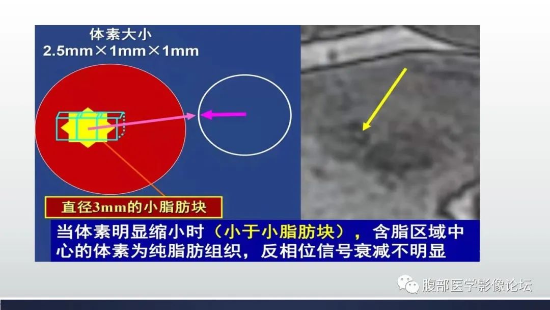 影像PPT - 【病例】肾脏血管平滑肌脂肪瘤1例MR-19