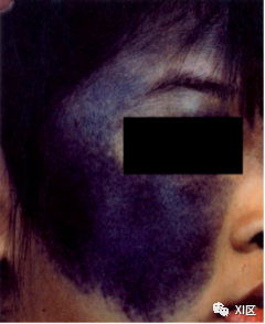影像PPT - “蓝脸的窦尔敦” 可能有哪些影像学表现?-11 影像PPT - “蓝脸的窦尔敦” 可能有哪些影像学表现?-11
