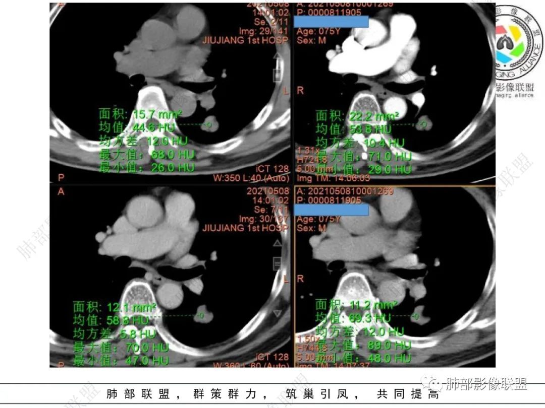 影像PPT - 【病例】看似“温和”的肺大细胞癌-3 影像PPT - 【病例】看似“温和”的肺大细胞癌-3