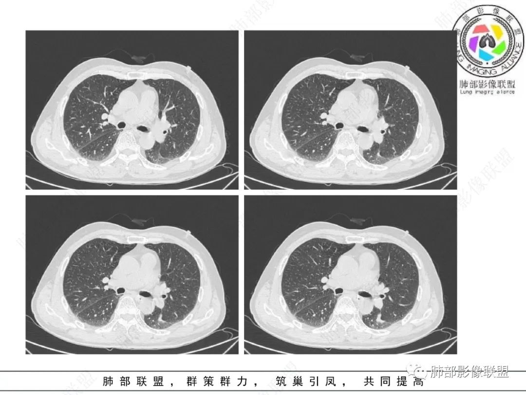 影像PPT - 【病例】看似“温和”的肺大细胞癌-4 影像PPT - 【病例】看似“温和”的肺大细胞癌-4