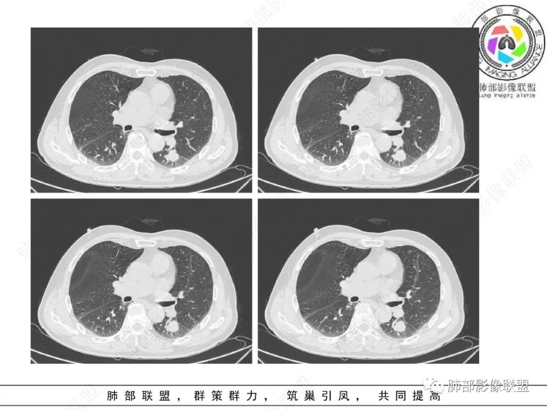影像PPT - 【病例】看似“温和”的肺大细胞癌-6 影像PPT - 【病例】看似“温和”的肺大细胞癌-6