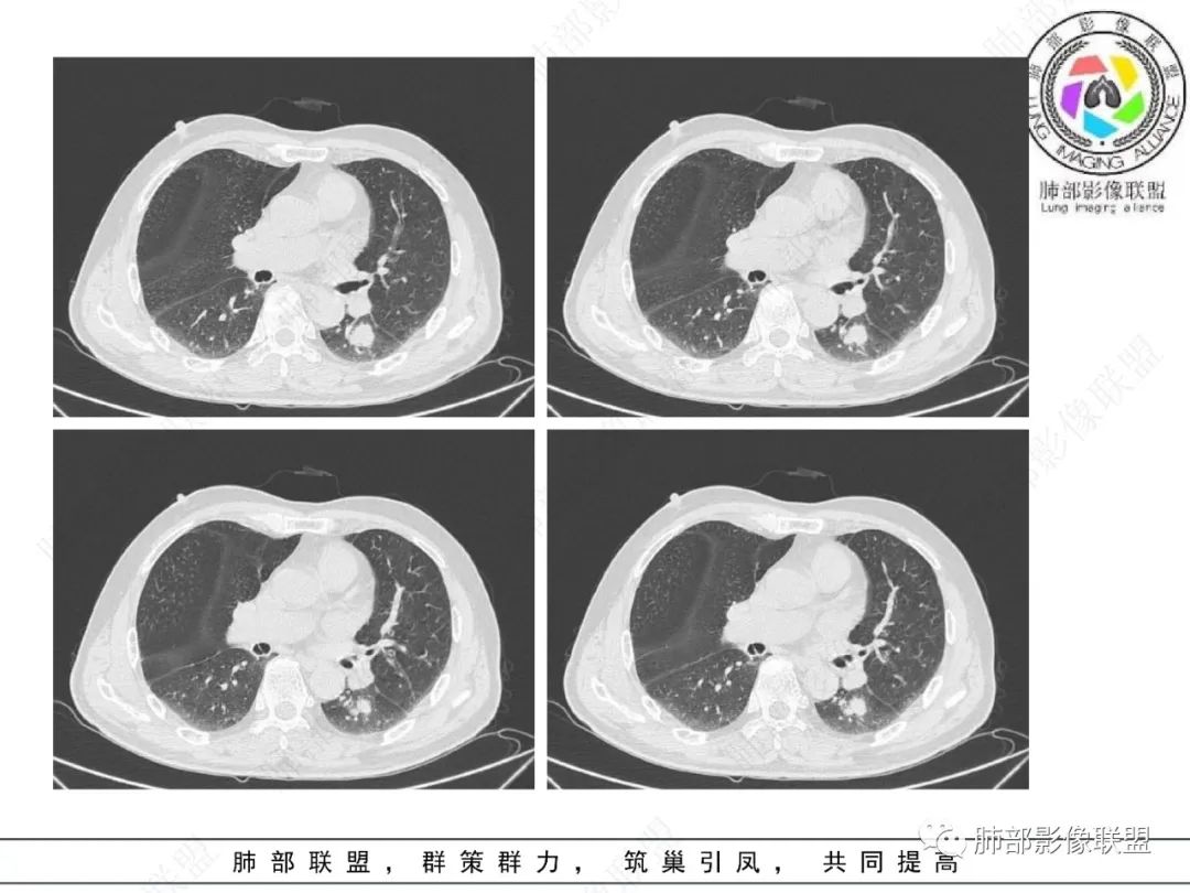 影像PPT - 【病例】看似“温和”的肺大细胞癌-7 影像PPT - 【病例】看似“温和”的肺大细胞癌-7