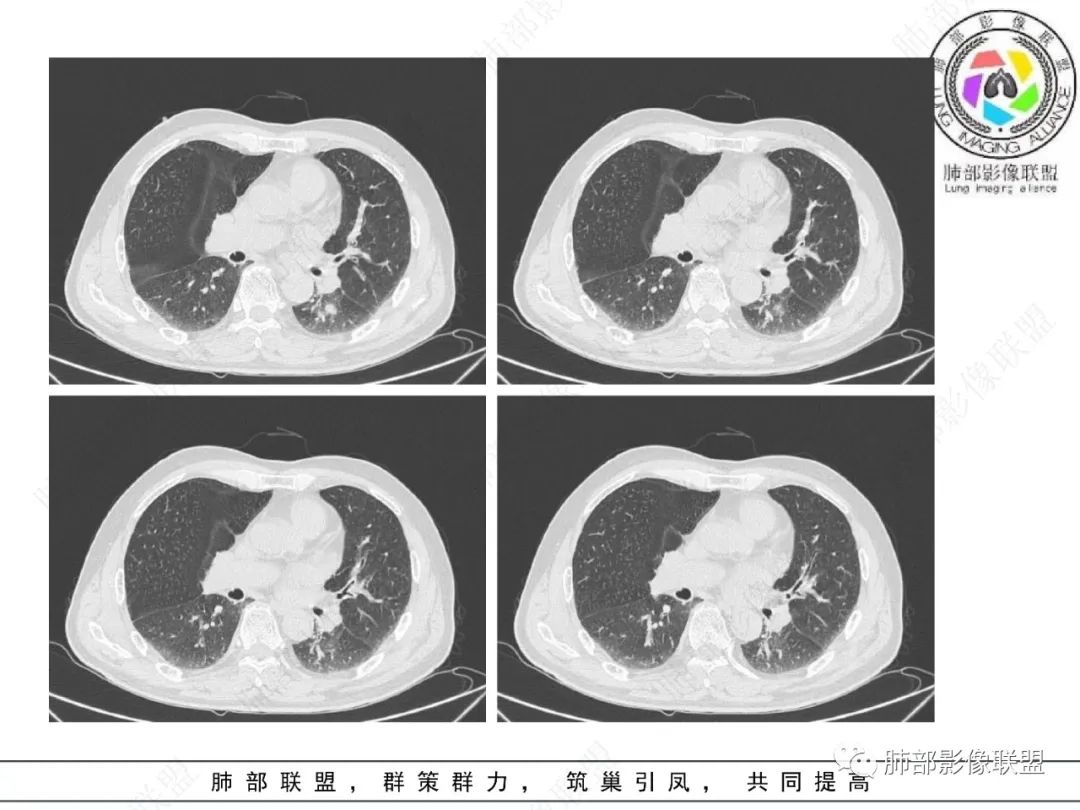 影像PPT - 【病例】看似“温和”的肺大细胞癌-8 影像PPT - 【病例】看似“温和”的肺大细胞癌-8