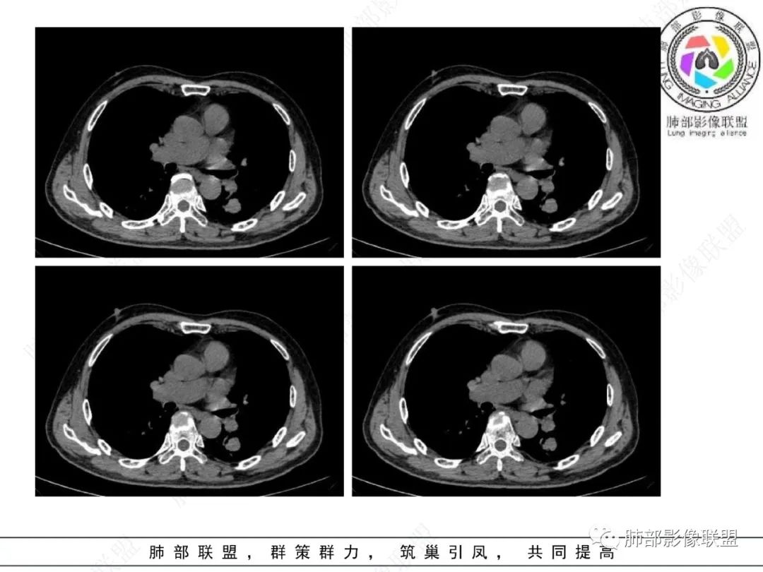 影像PPT - 【病例】看似“温和”的肺大细胞癌-11 影像PPT - 【病例】看似“温和”的肺大细胞癌-11