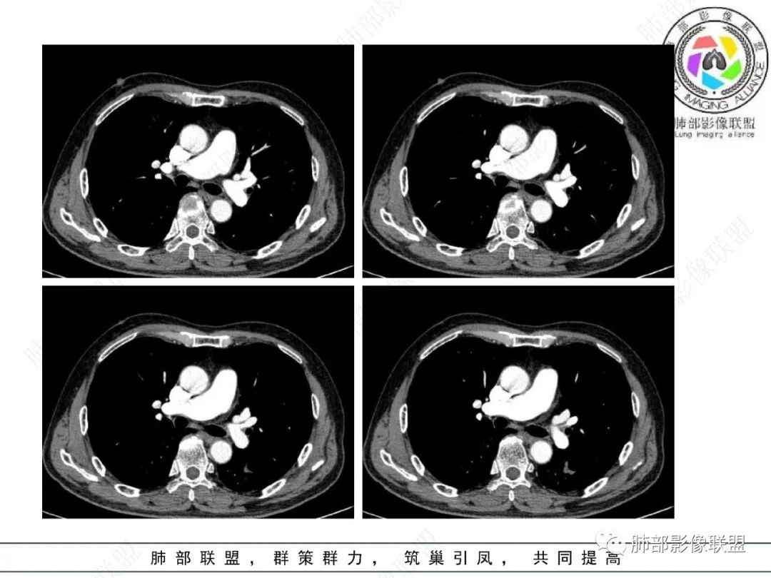 影像PPT - 【病例】看似“温和”的肺大细胞癌-14 影像PPT - 【病例】看似“温和”的肺大细胞癌-14