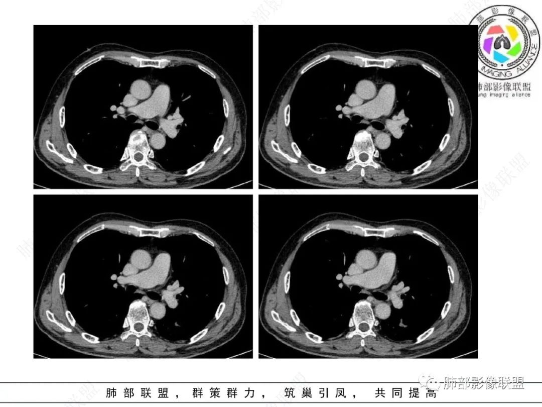 影像PPT - 【病例】看似“温和”的肺大细胞癌-19 影像PPT - 【病例】看似“温和”的肺大细胞癌-19