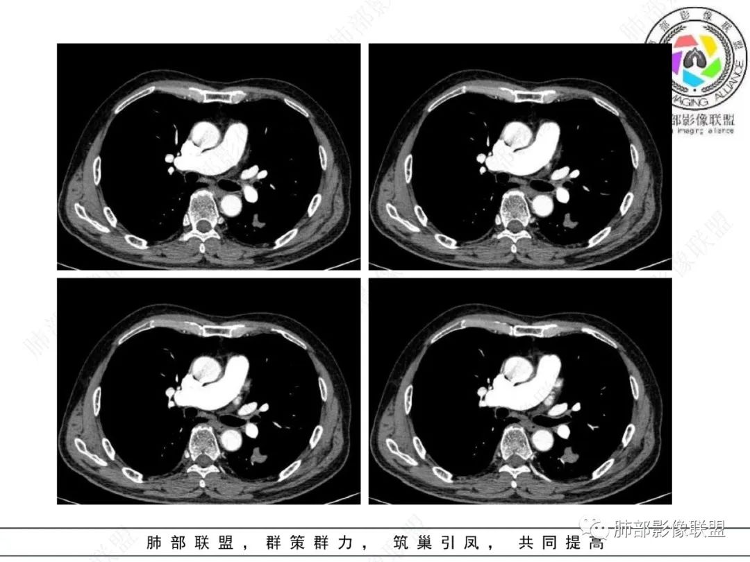 影像PPT - 【病例】看似“温和”的肺大细胞癌-15 影像PPT - 【病例】看似“温和”的肺大细胞癌-15