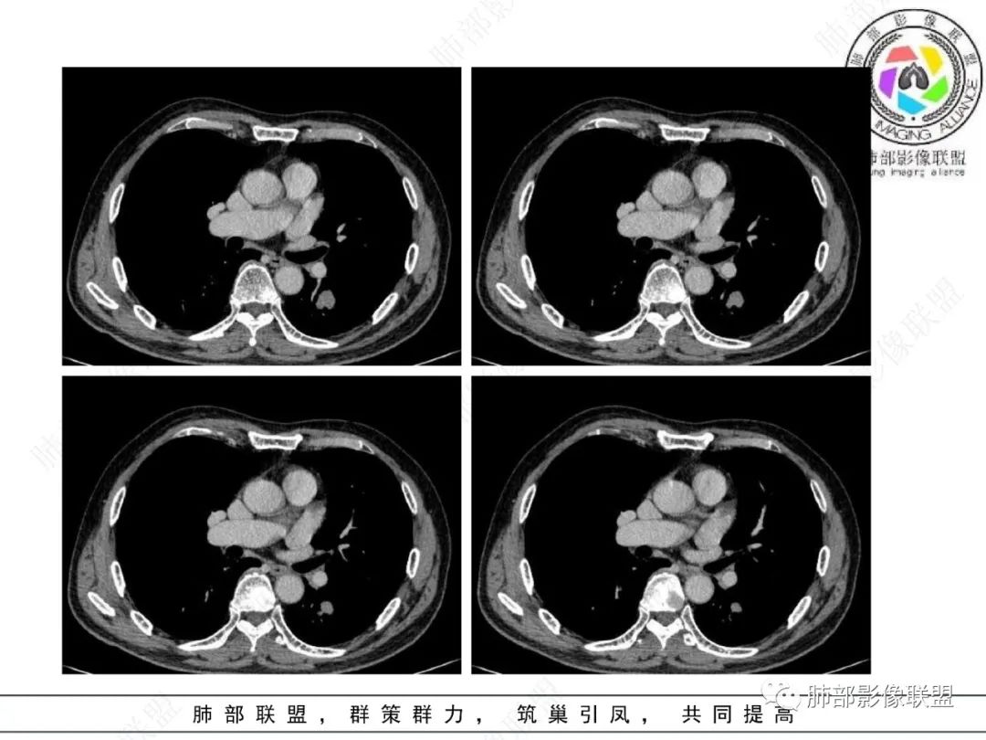 影像PPT - 【病例】看似“温和”的肺大细胞癌-22 影像PPT - 【病例】看似“温和”的肺大细胞癌-22
