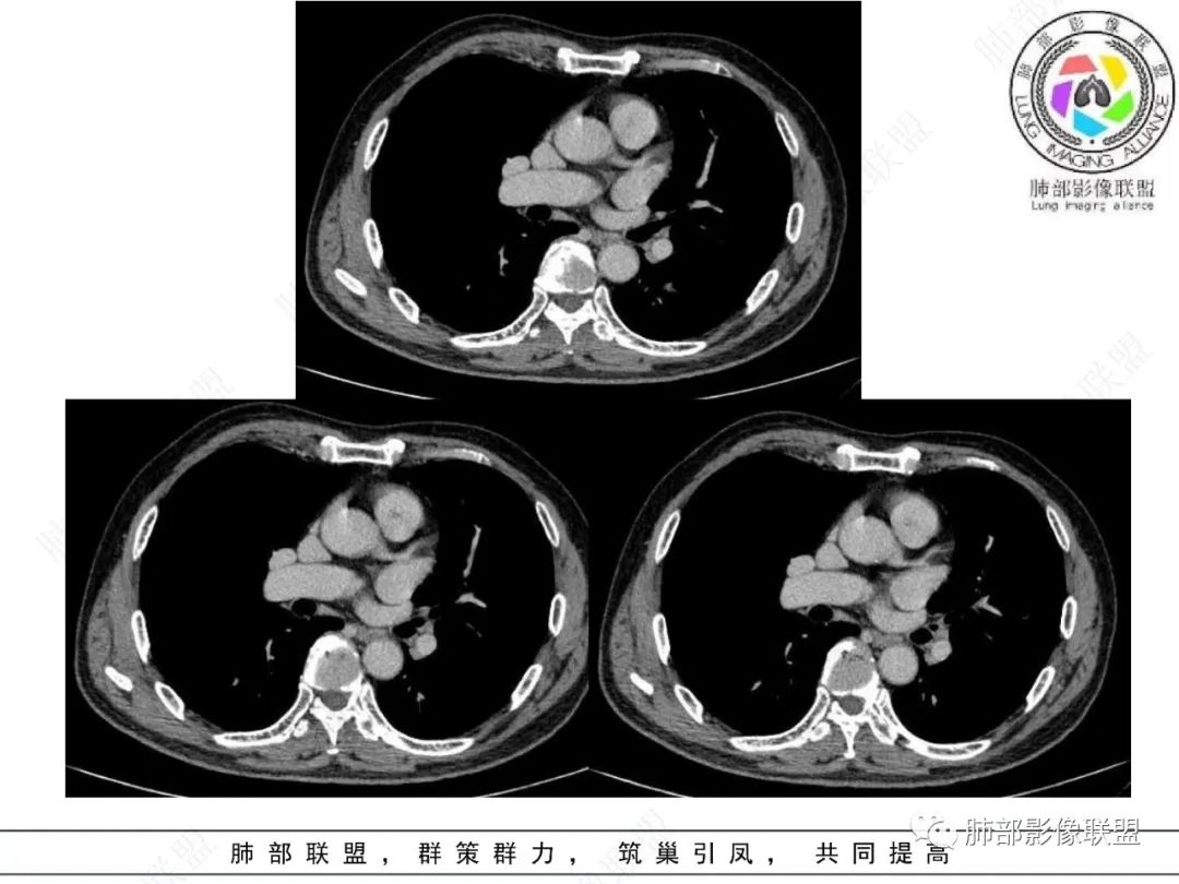 影像PPT - 【病例】看似“温和”的肺大细胞癌-23 影像PPT - 【病例】看似“温和”的肺大细胞癌-23