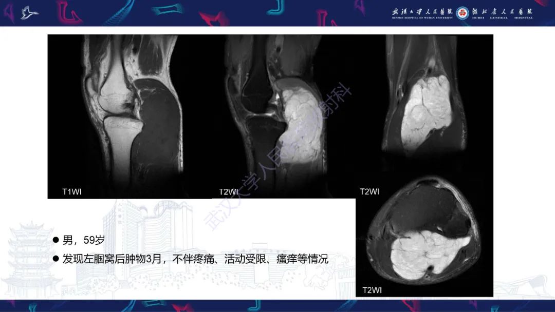 影像PPT - 【PPT】骨外粘液样软骨肉瘤影像诊断-3