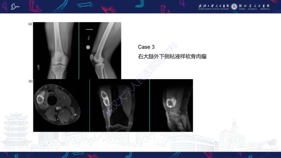 影像PPT - 【PPT】骨外粘液样软骨肉瘤影像诊断-14