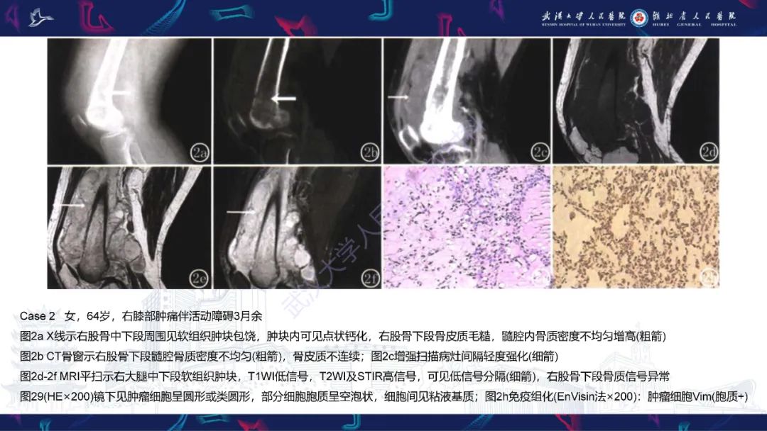 影像PPT - 【PPT】骨外粘液样软骨肉瘤影像诊断-13