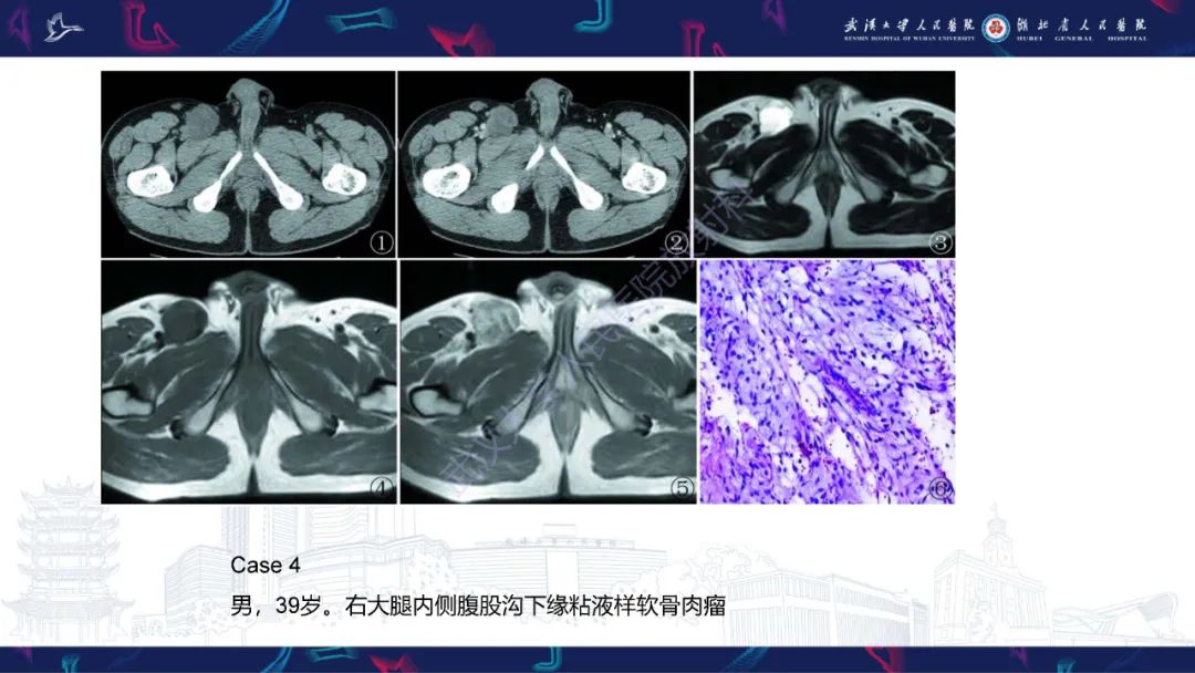影像PPT - 【PPT】骨外粘液样软骨肉瘤影像诊断-15